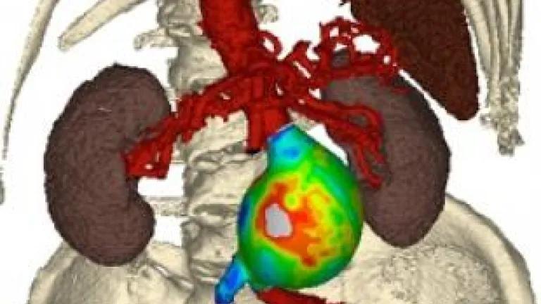 Visualisation of wall stress in a large patient specific abdominal aortic aneurysm