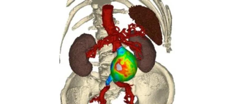 Visualisation of wall stress in a large patient specific abdominal aortic aneurysm (Dr Noel Conlisk)